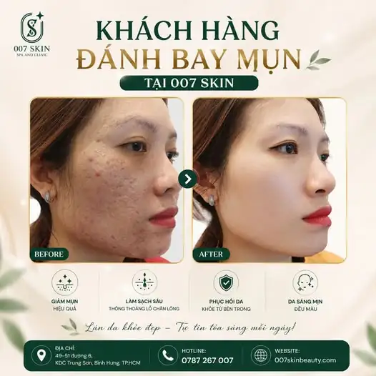 TẠM BIỆT MỤN VIÊM - ĐÓN DA SÁNG MỊN CÙNG 007 SKIN 💚