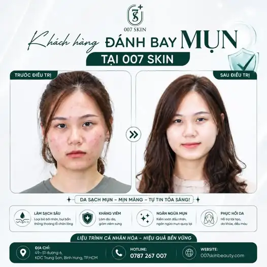 TẠM BIỆT MỤN VIÊM – ĐÓN DA SÁNG MỊN CÙNG LIỆU TRÌNH CÁ NHÂN HÓA