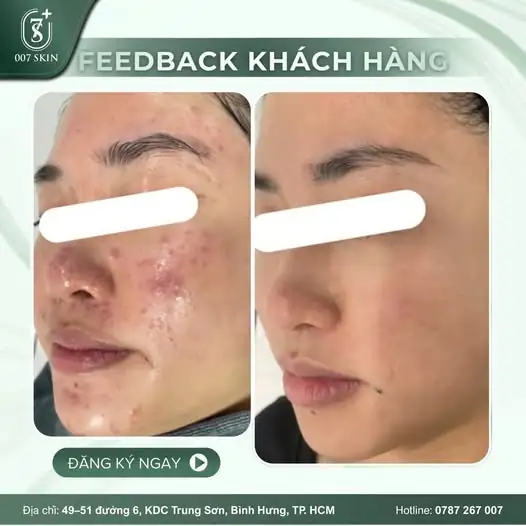 TẠM BIỆT MỤN VIÊM – TỰ TIN VỚI DIỆN MẠO MỚI ✨