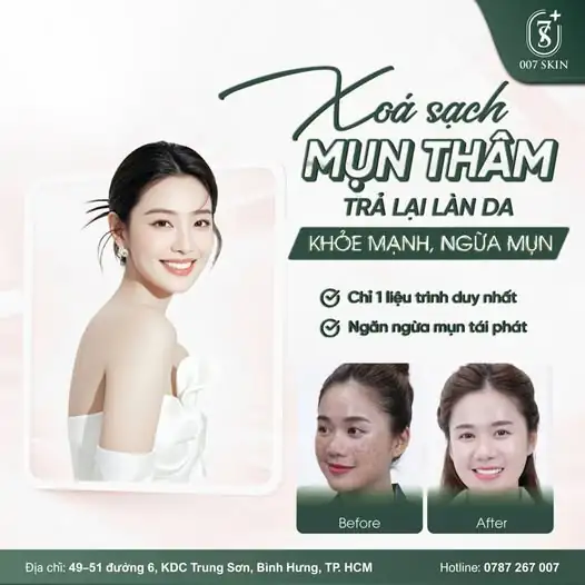 TẠM BIỆT NỖI LO MỤN THÂM – LẤY LẠI LÀN DA RẠNG RỠ CHỈ SAU 1 LIỆU TRÌNH! ✨
