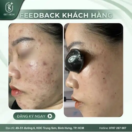 TẠM BIỆT NỖI LO MỤN VIÊM – HÀNH TRÌNH TÌM LẠI LÀN DA CĂNG BÓNG ✨