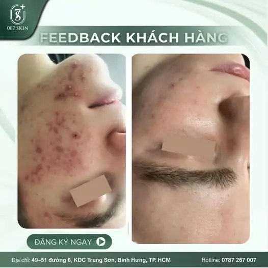 TẠM BIỆT NỖI LO MỤN VIÊM - TỰ TIN KHOE DA MỘC RẠNG RỠ! 📸