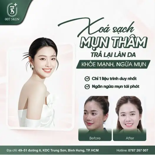 TẠM BIỆT THÂM MỤN – TRẢ LẠI LÀN DA PHA LÊ ✨