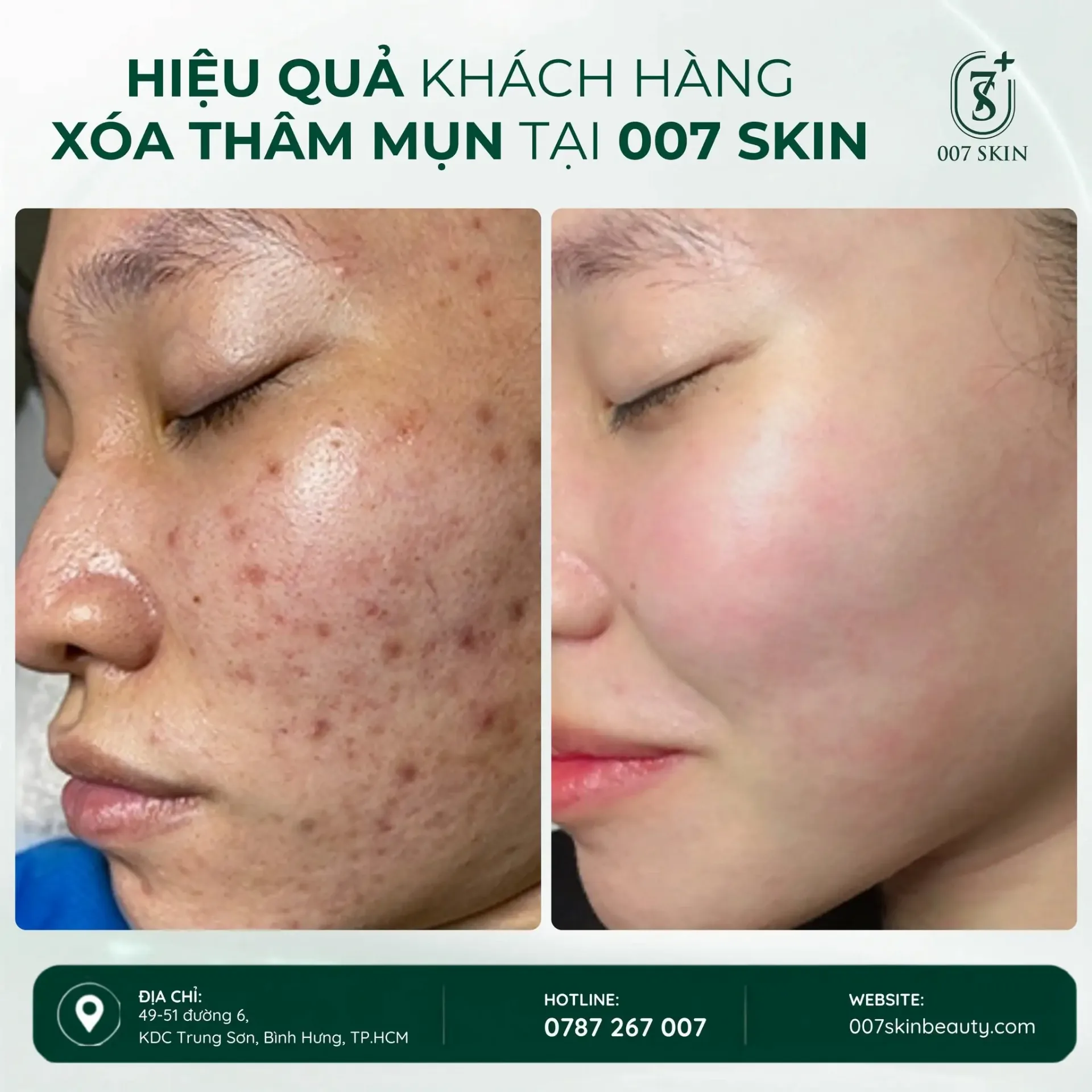 TẠM BIỆT THÂM MỤN – TỰ TIN KHOE LÀN DA MỘC!