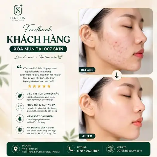 TIẾC GÌ 1 LIỆU TRÌNH – ĐỔI LẠI LÀN DA SẠCH MỤN, SÁNG MỊN KHÔNG TỲ VẾT! ✨