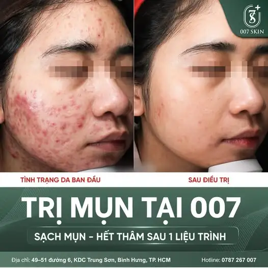 TIẾC GÌ THÌ TIẾC - ĐỪNG ĐỂ TIẾC MỘT CHIẾC DA XINH ĐÓN TẾT! 🧧