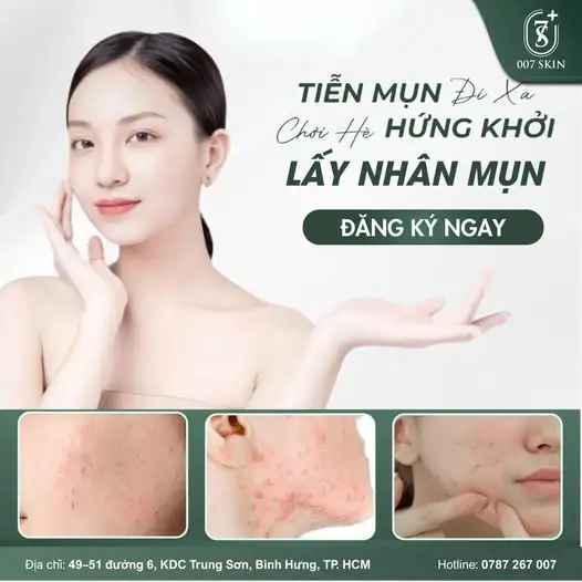 TIỄN MỤN ĐI XA – CHƠI HÈ HỨNG KHỞI CÙNG 007 SKIN! ☀️🌊