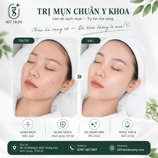 TRỊ MỤN CHUẨN Y KHOA – TỰ TIN KHOE DA MỘC RẠNG RỠ ✨