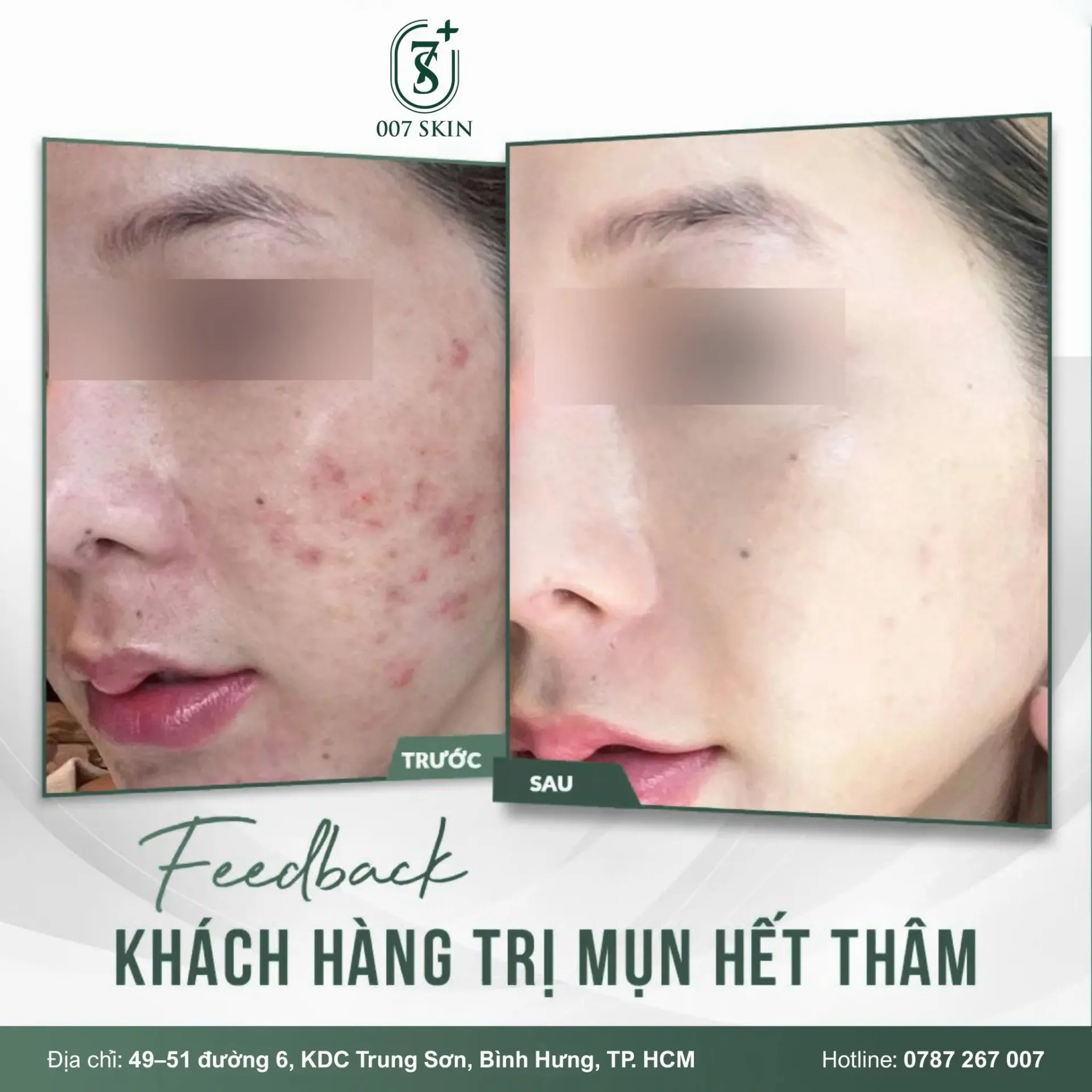 TRỊ MỤN HẾT THÂM – TỰ TIN TỎA SÁNG VỚI LÀN DA MỊN MÀNG