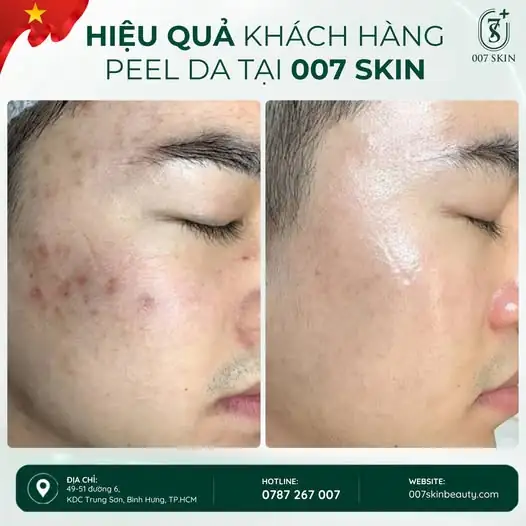 TỪ LÀN DA NHIỀU KHUYẾT ĐIỂM → DIỆN MẠO TƯƠI SÁNG HƠN 💚