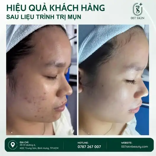 TỪ LÀN DA NHIỀU MỤN ĐẾN DIỆN MẠO DA SẠCH VÀ MỊN HƠN 🌿