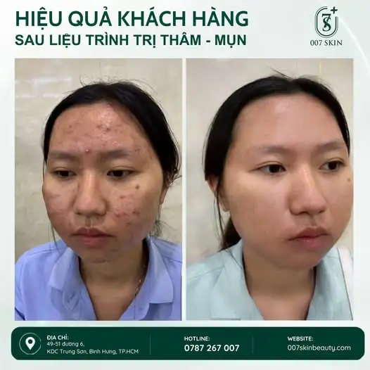 TỪ LÀN DA NHIỀU MỤN ĐẾN LÀN DA THOÁNG MỊN HƠN 🌿