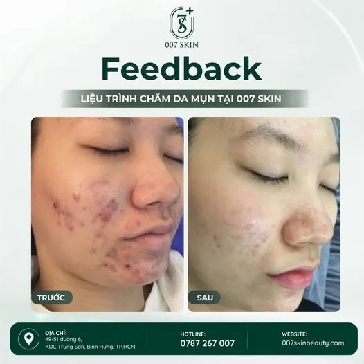 ✨ DA MỤN ĐỪNG LO – ĐÃ CÓ LIỆU TRÌNH CHĂM SÓC DA CHUYÊN SÂU! ✨