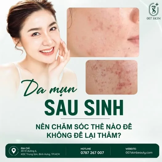 🌿 DA MỤN SAU SINH – ĐỪNG ĐỂ NHỮNG VẾT THÂM LÀM BẠN MẤT TỰ TIN!