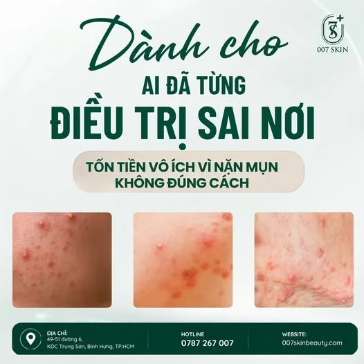 ĐỪNG ĐỂ TIỀN MẤT – MỤN VẪN CỨ QUAY LẠI! 😣