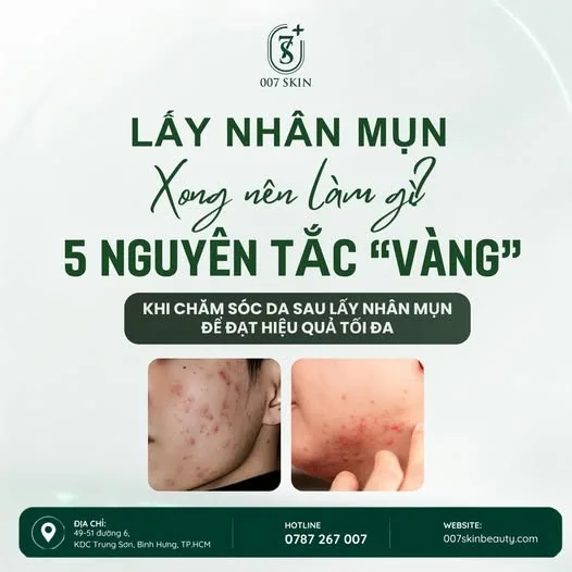 🌿 LẤY NHÂN MỤN XONG NÊN LÀM GÌ? 5 NGUYÊN TẮC GIÚP DA PHỤC HỒI TỐT HƠN!