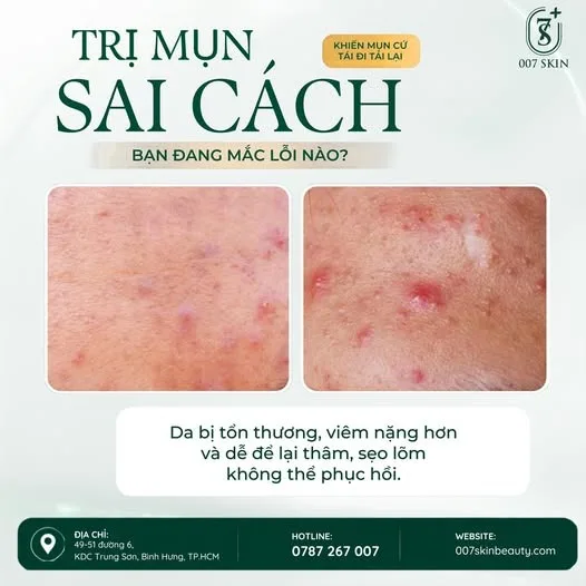 MỤN CỨ TÁI ĐI TÁI LẠI? Có thể bạn đang mắc sai lầm trong cách xử lý mụn! 😥