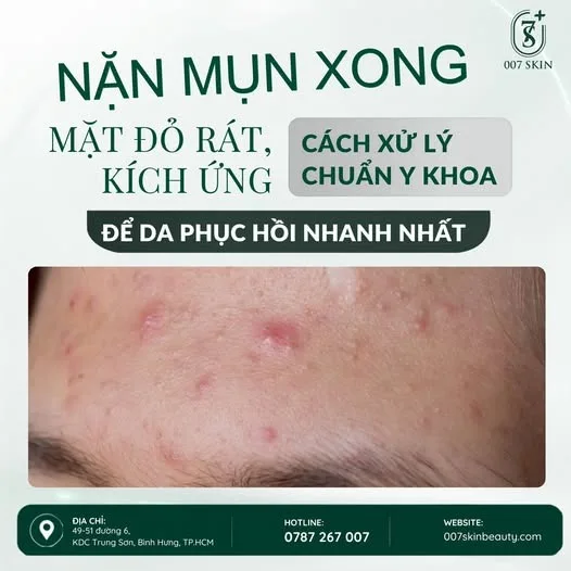 🚨 NẶN MỤN XONG, MẶT ĐỎ RÁT, KÍCH ỨNG? ĐỪNG VỘI CHĂM DA THEO CẢM TÍNH!
