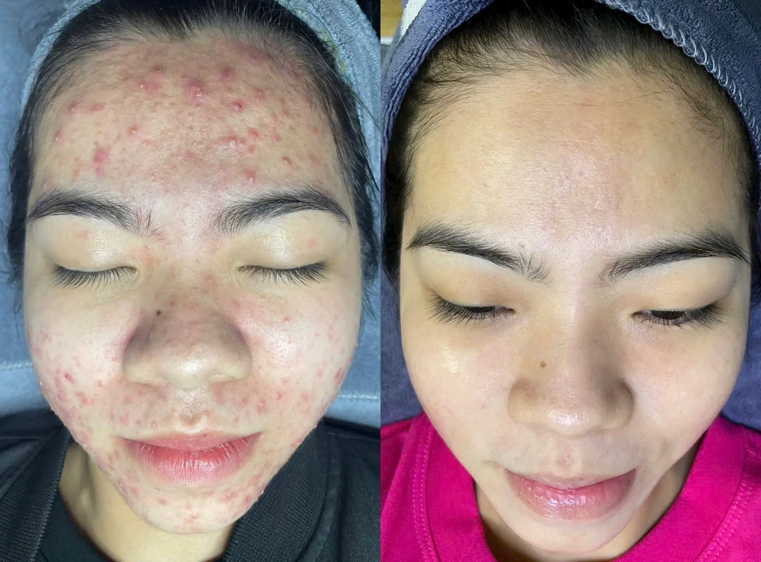 Trị Mụn Chuẩn Y Khoa KDC Trung Sơn An Toàn Tận Gốc - 007 Skin Beauty