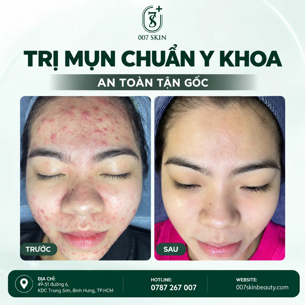 Trị Mụn Chuẩn Y Khoa KDC Trung Sơn An Toàn Tận Gốc - 007 Skin Beauty