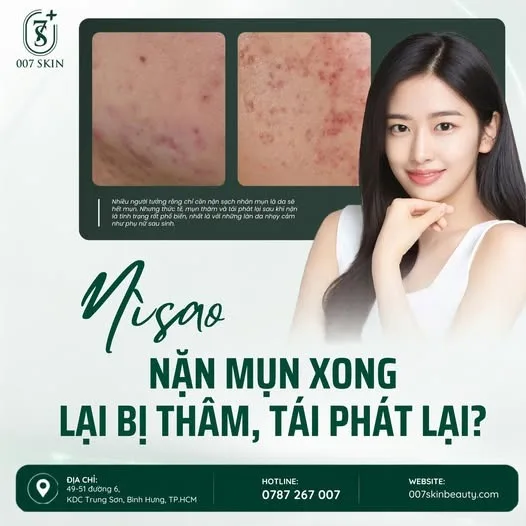 VÌ SAO NẶN MỤN XONG VẪN BỊ THÂM, MỤN CÒN TÁI PHÁT? 🤔